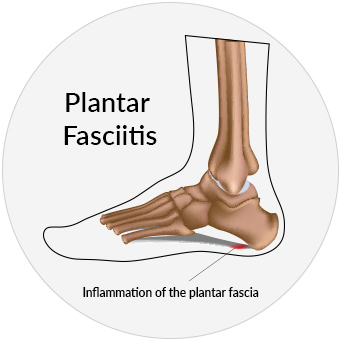 Medical illustration of an inflamed plantar fascia due to plantar fasciitis